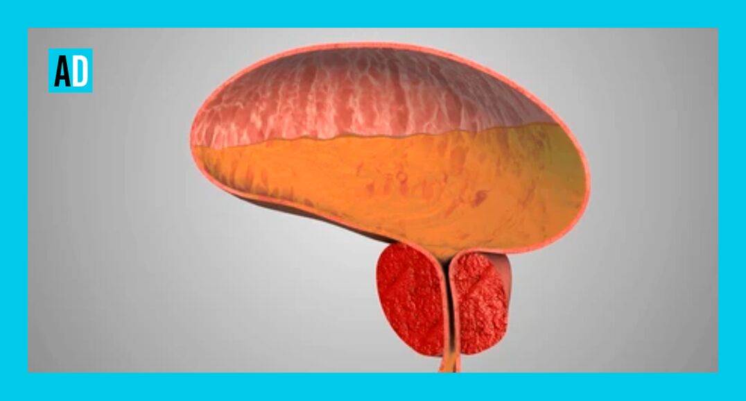 Φλεγμονή του προστάτη